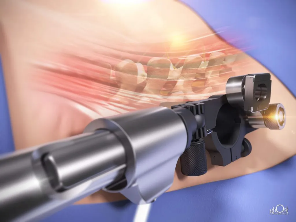 Spineology medical device illustration 